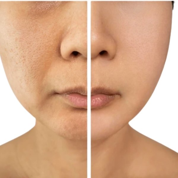 Skin Rejuvenation treatment result